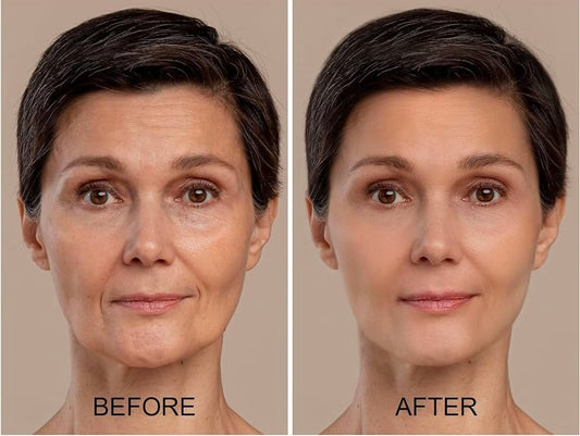 Needle Free Botox